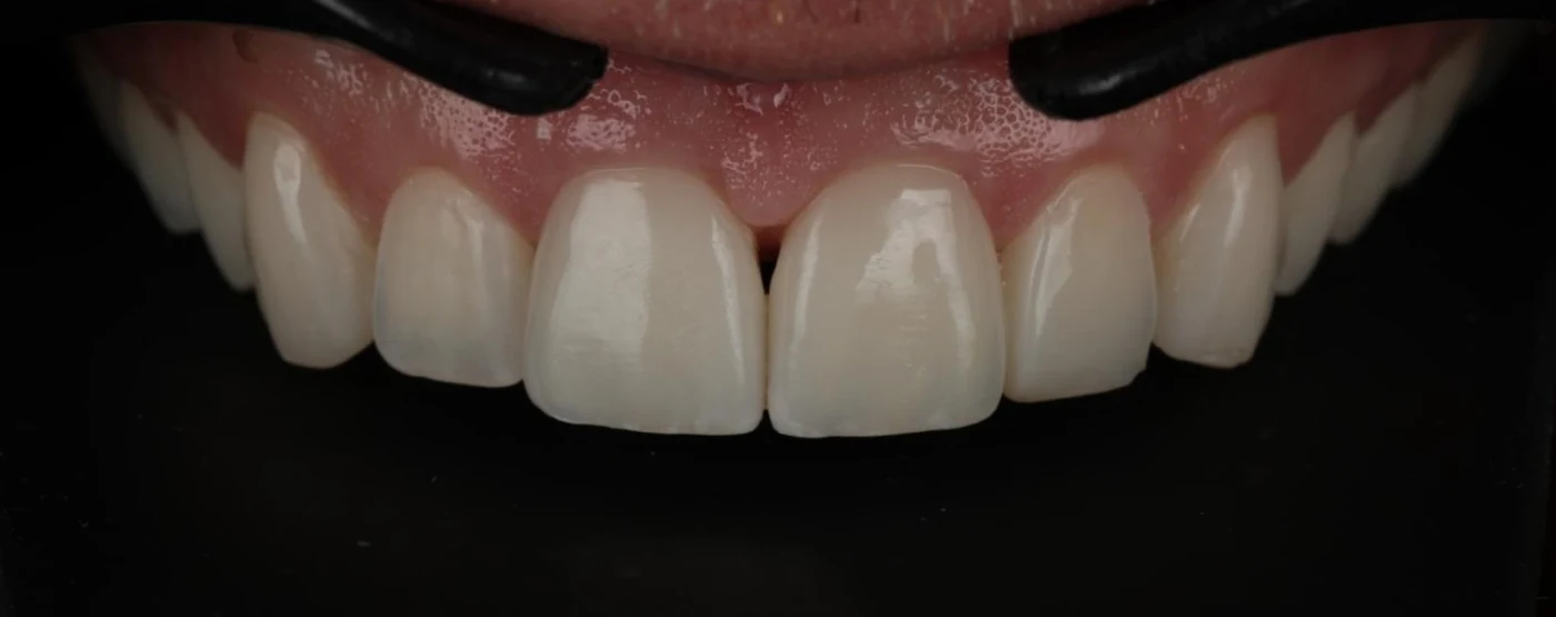 After treatment: restored upper front teeth, close-up