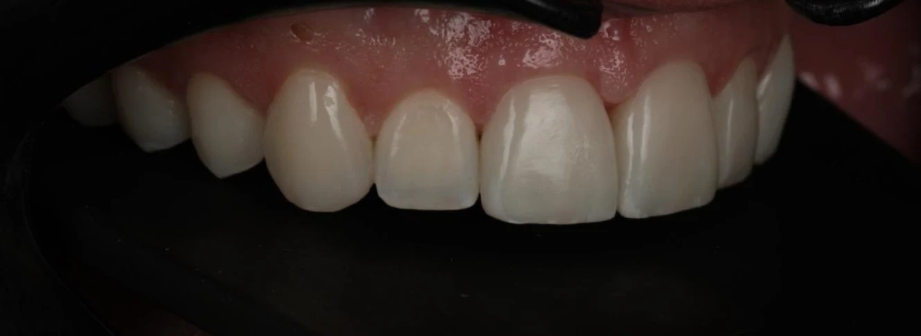 After treatment: restored upper teeth, side view