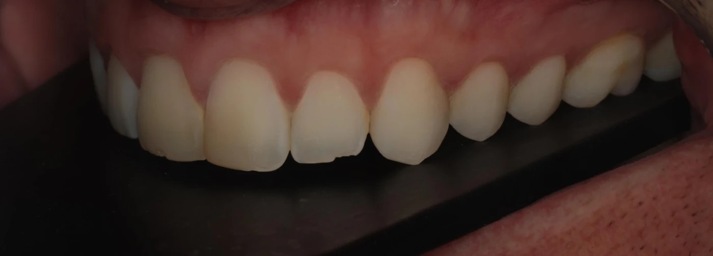 Before treatment: worn upper teeth, side view